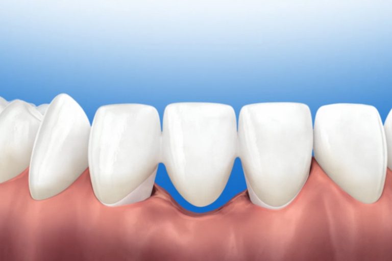 Extraction dentaire: quelles répercussions pour votre santé ?