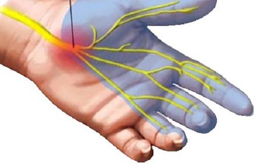 Syndrome du canal carpien : quels symptômes ?